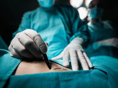 Brustvergrößerung mit Straffung: Welche Fragen sollten Sie stellen?