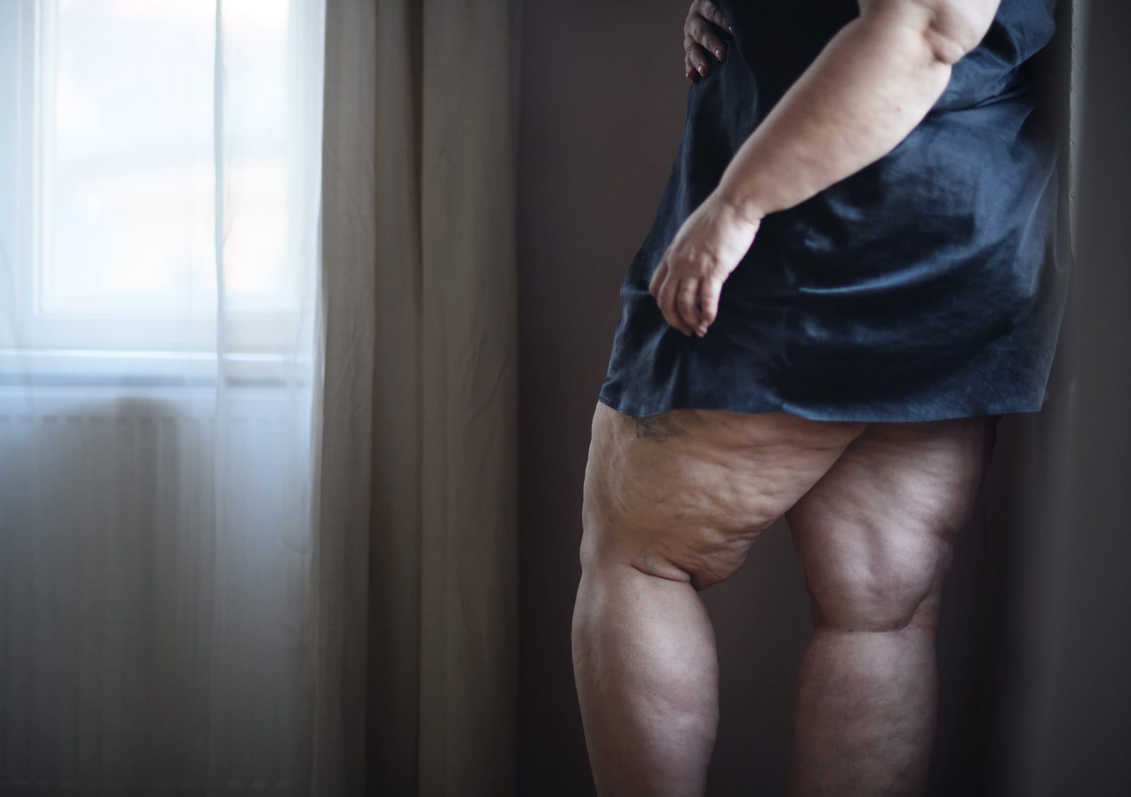Lipödem Behandlung: So erkennen Sie die ersten Symptome rechtzeitig